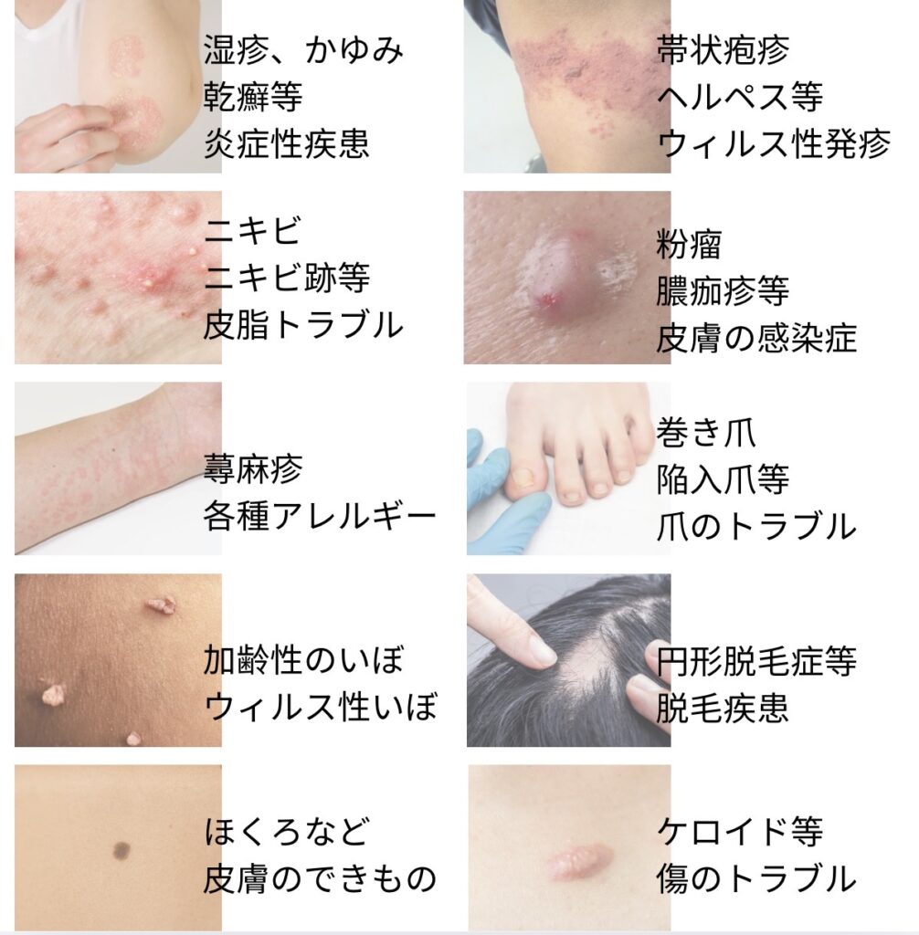 下北沢スキンクリニックが取り扱う皮膚科疾患を示した画像