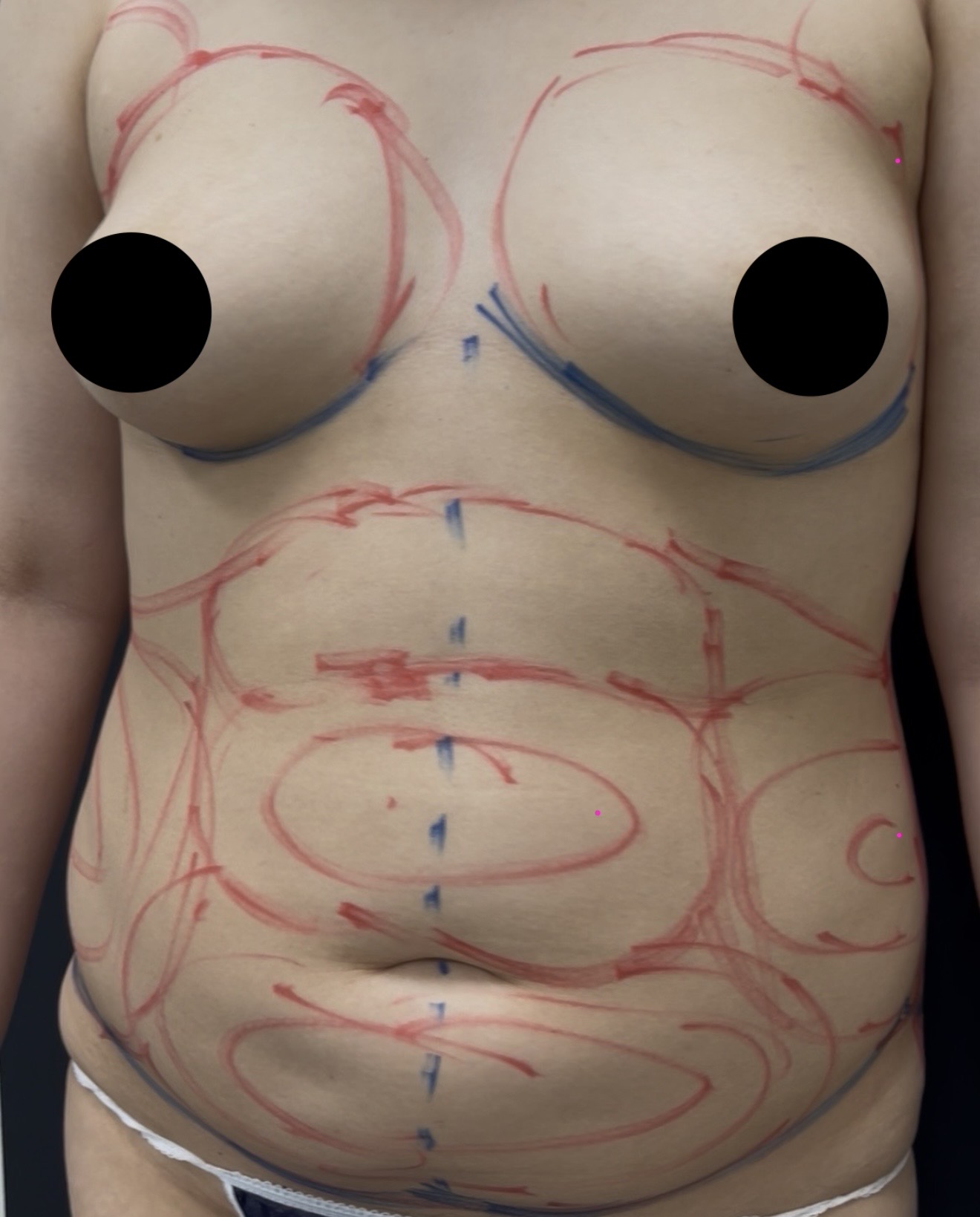 腹部からの脂肪豊胸を行う際のデザイン