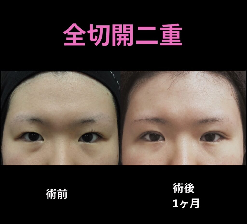 二重全切開二重術の術前後写真