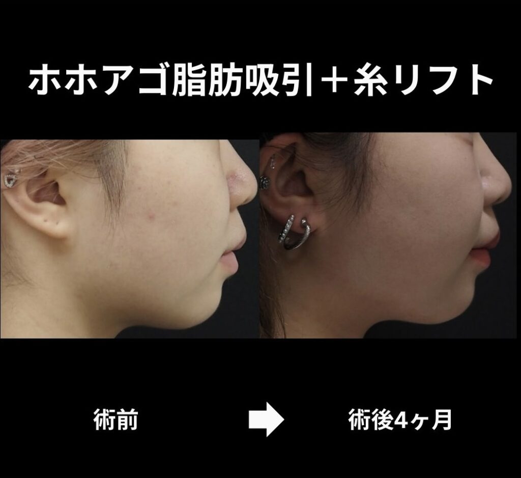 顔脂肪吸引＋糸リフトの症例写真