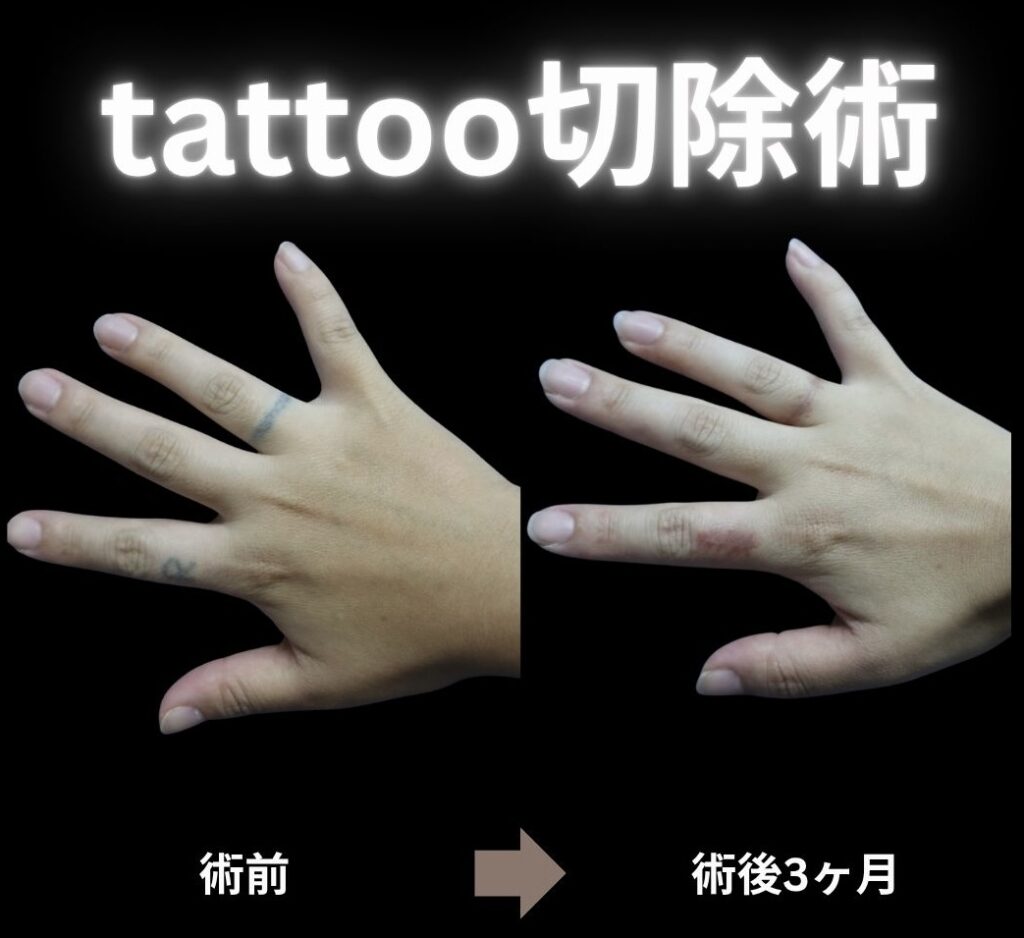 tattoo切除術(手)の症例写真