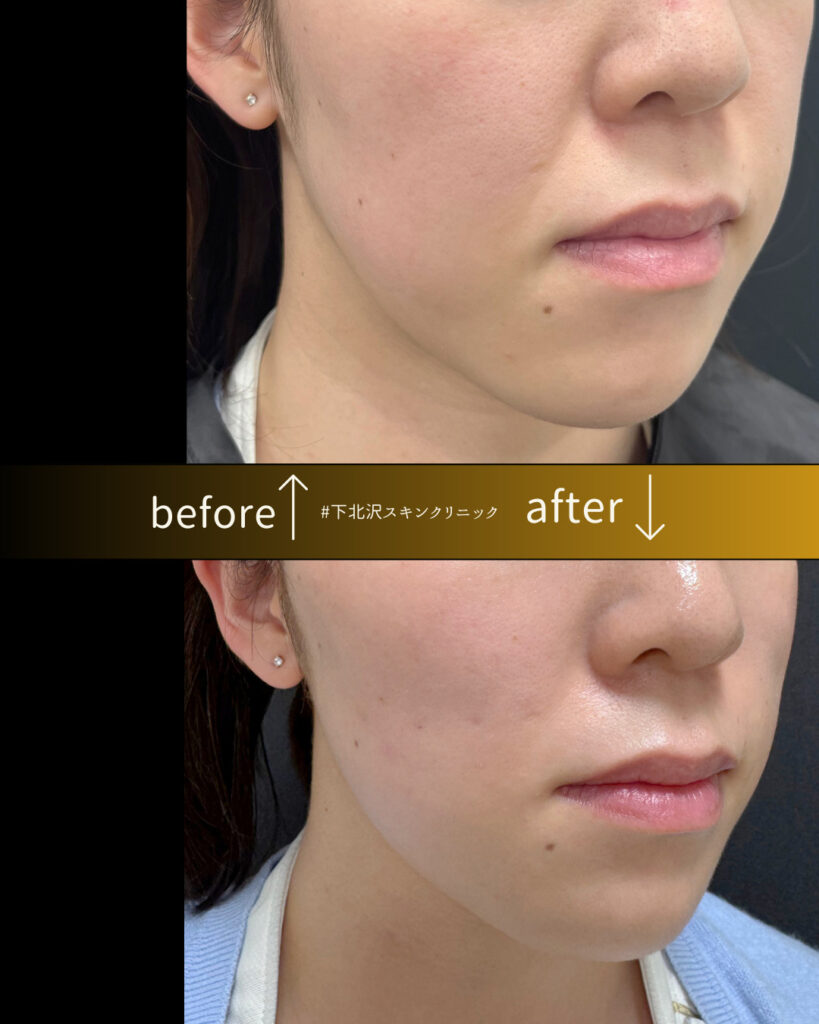 ほうれい線に対するスレッドリフト