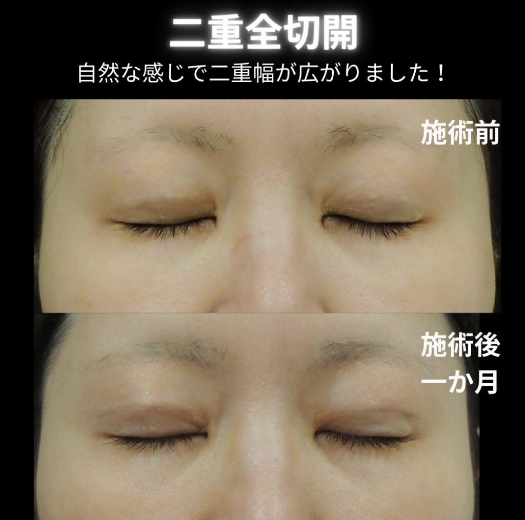 二重全切開の症例