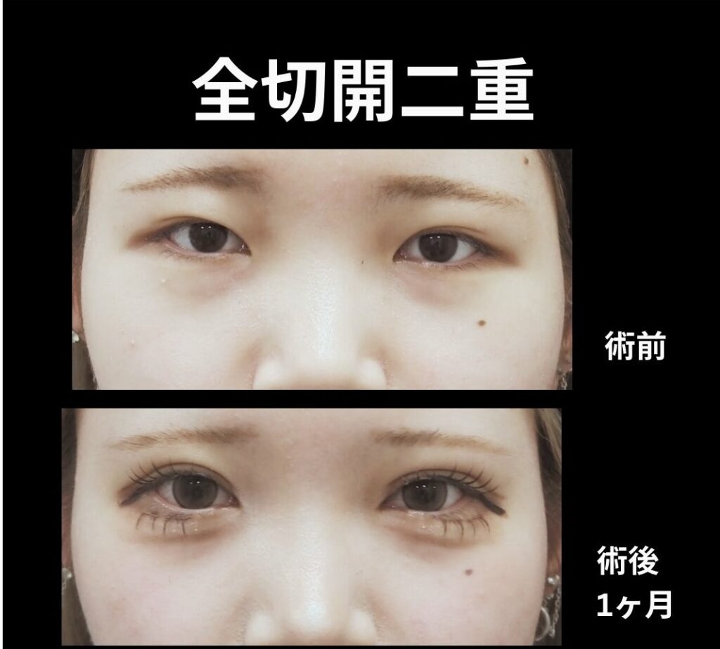 全切開二重術の症例
