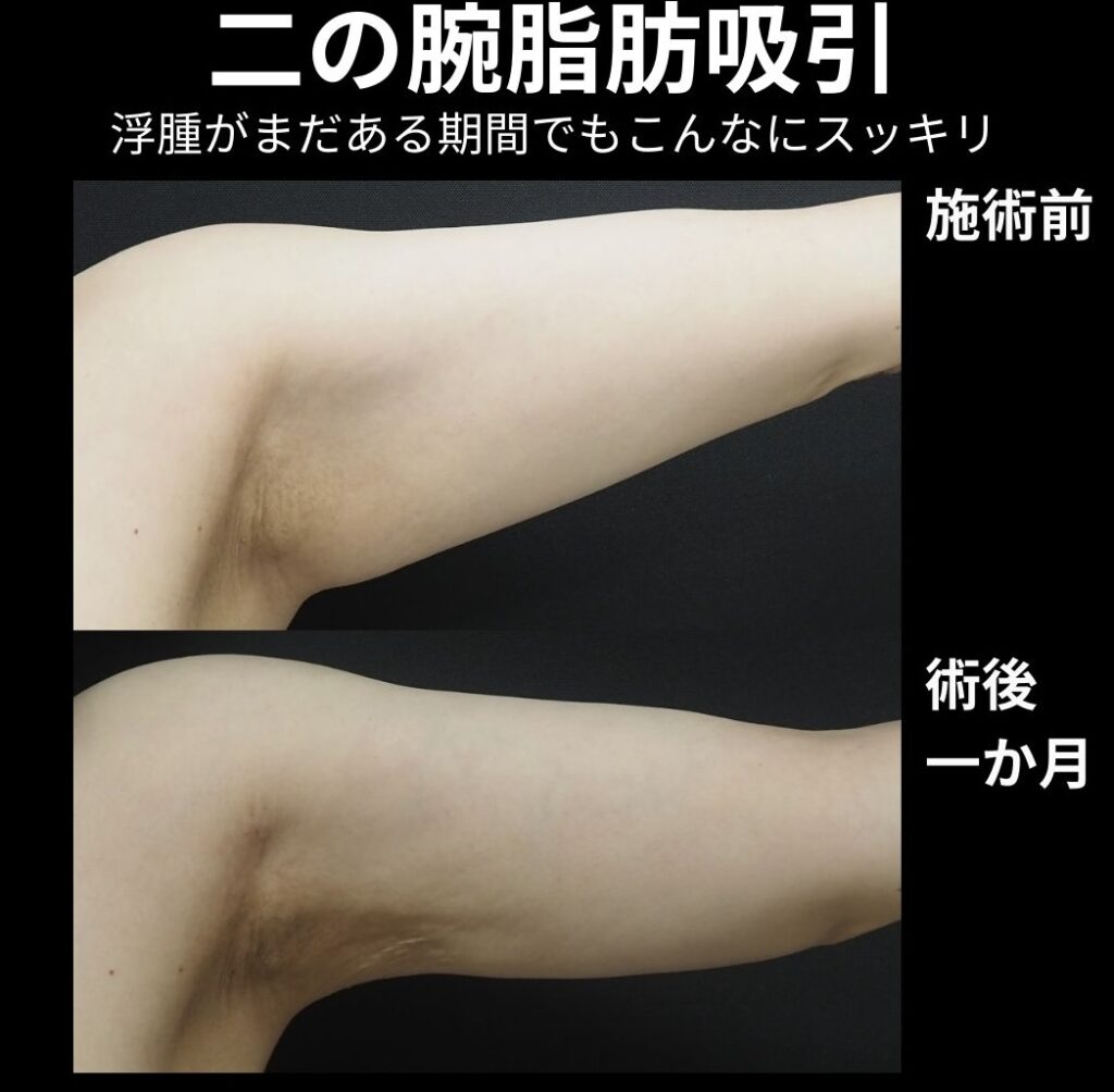 二の腕全体脂肪吸引の症例写真