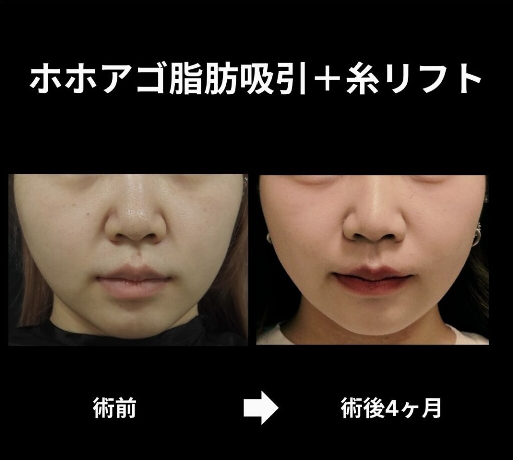 顔脂肪吸引＋糸リフトの症例写真