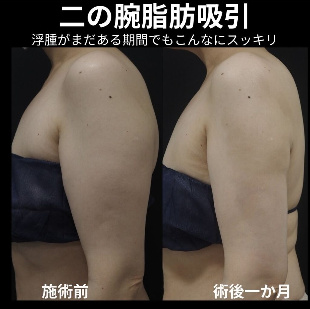 二の腕全体脂肪吸引の症例写真