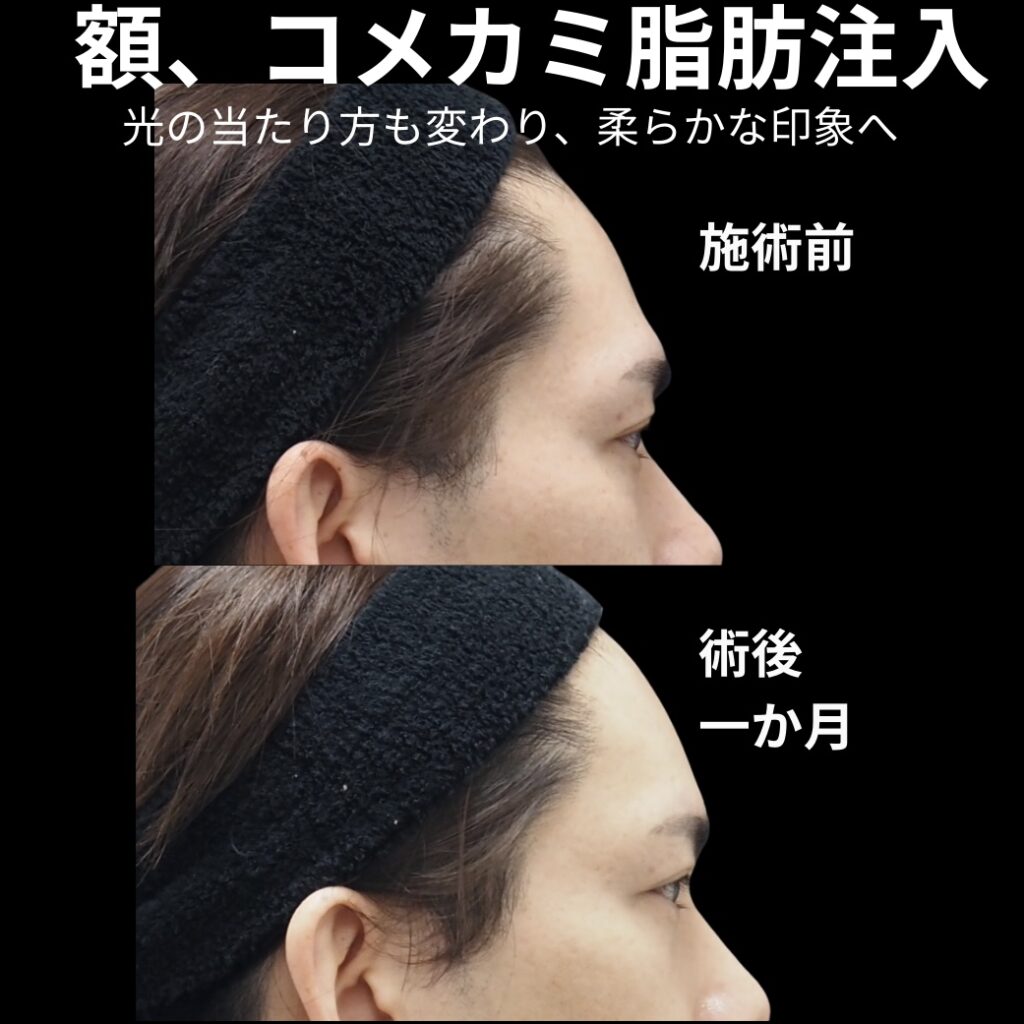 額・こめかみの脂肪注入に関する症例写真