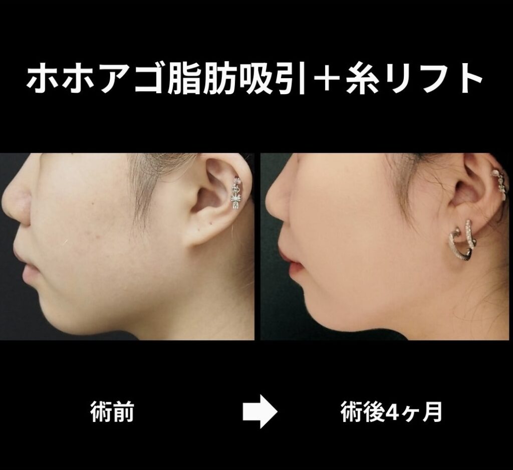 顔脂肪吸引＋糸リフトの症例写真