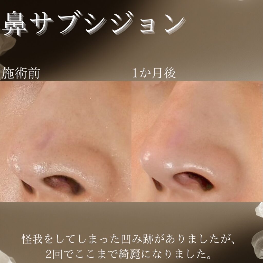 鼻に存在するキズアトに対するサブシジョン症例