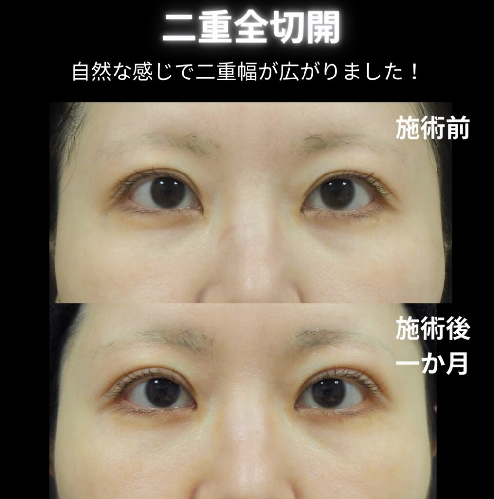 二重全切開の症例