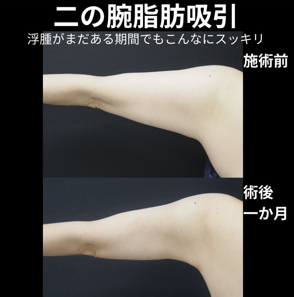 二の腕全体脂肪吸引の症例写真