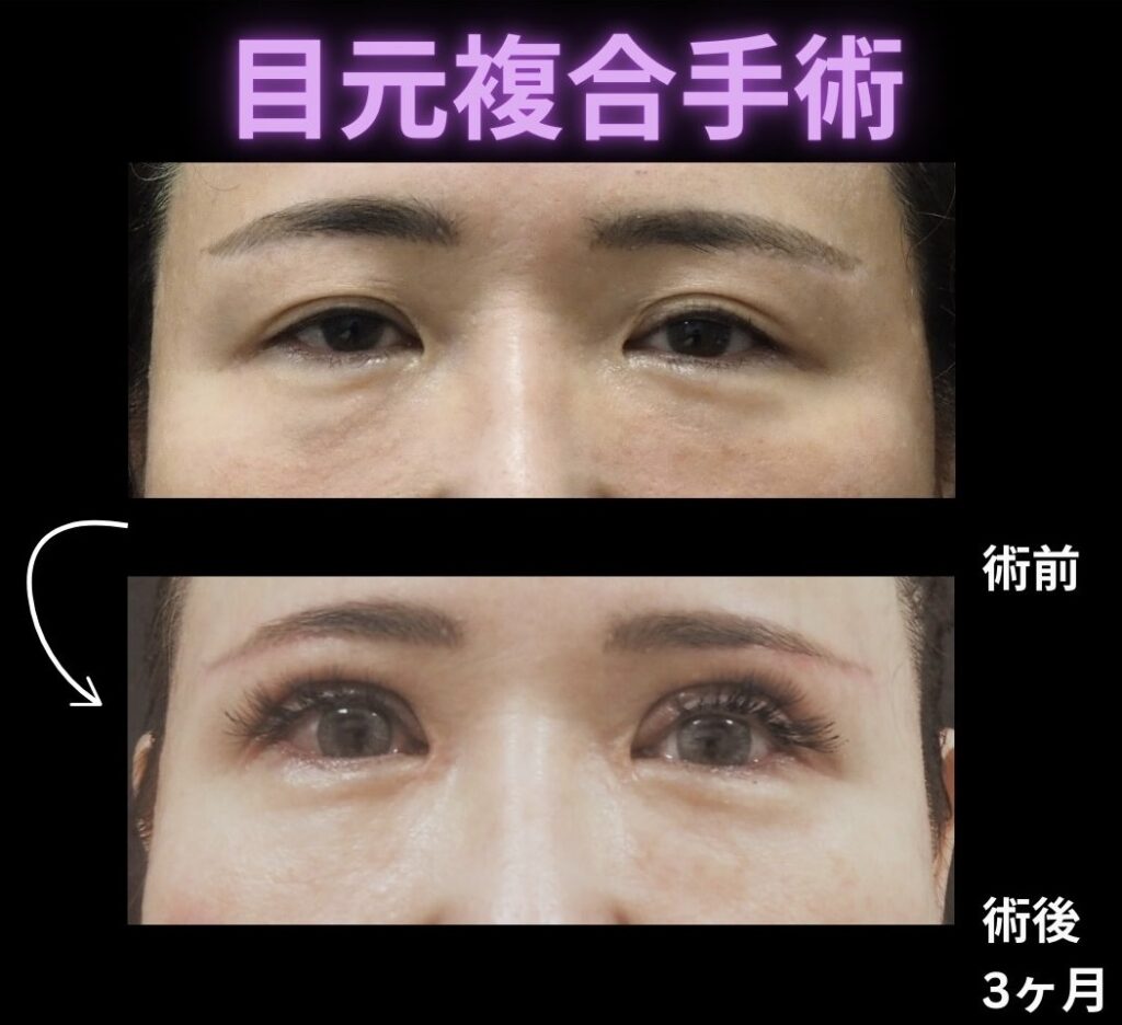 目元複合手術の症例写真