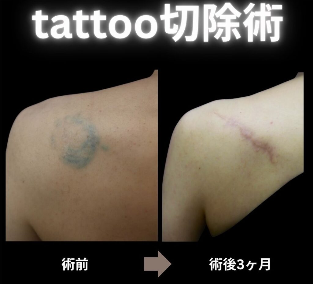 tattoo切除術の症例写真
