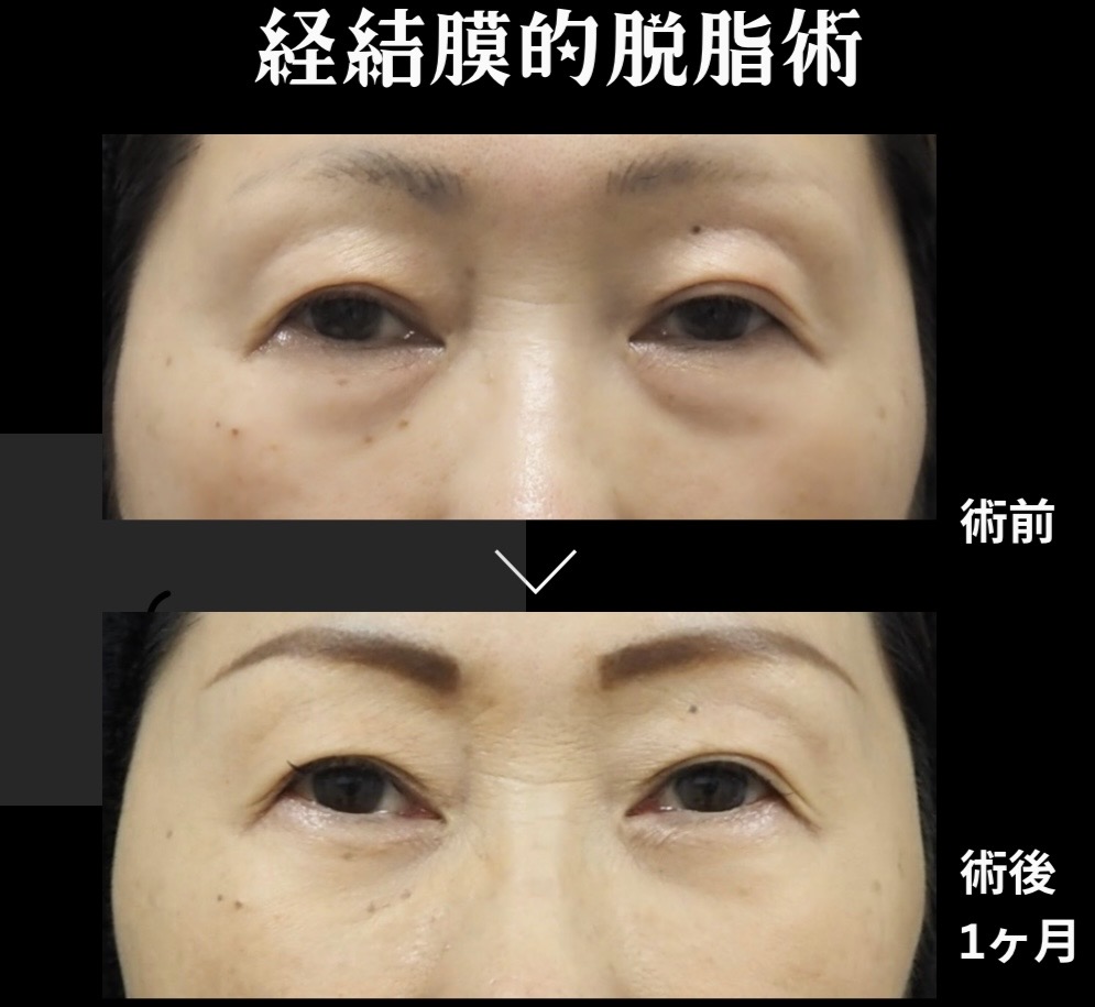 経結膜的脱脂術の症例