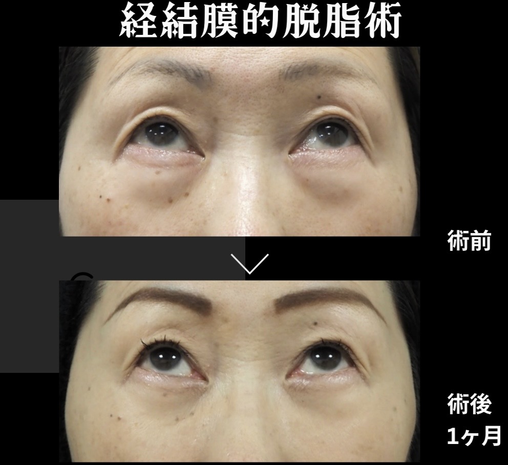 経結膜的脱脂術の症例