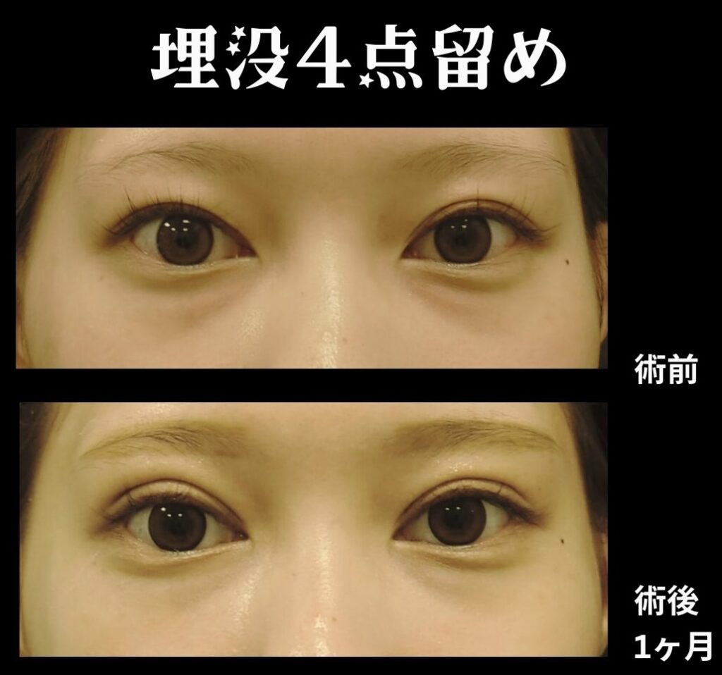 埋没４点留めの症例写真