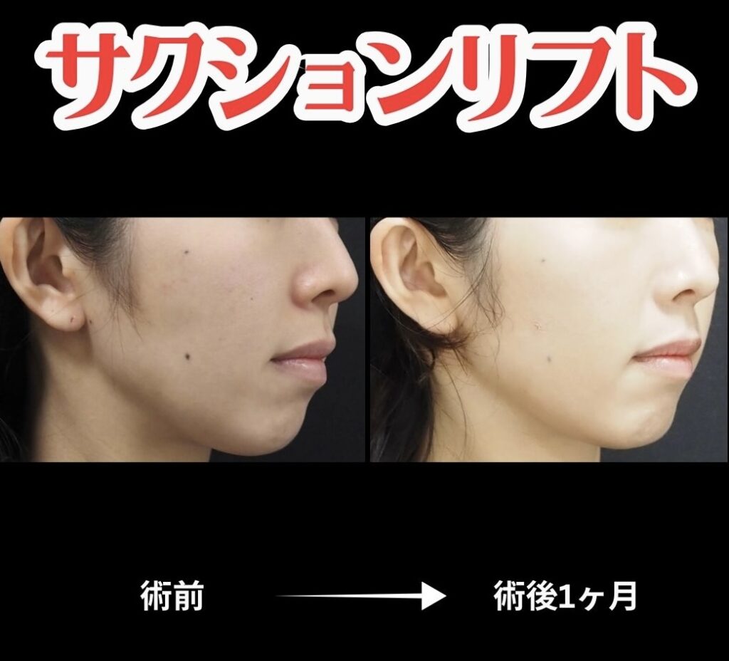サクションリフトの術前術後比較写真