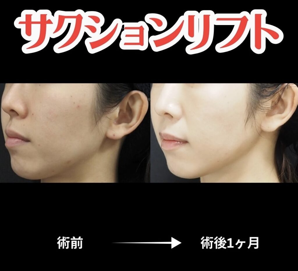 サクションリフトの術前術後比較写真