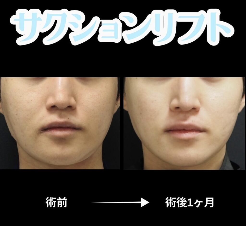 サクションリフト(メンズ)の症例写真