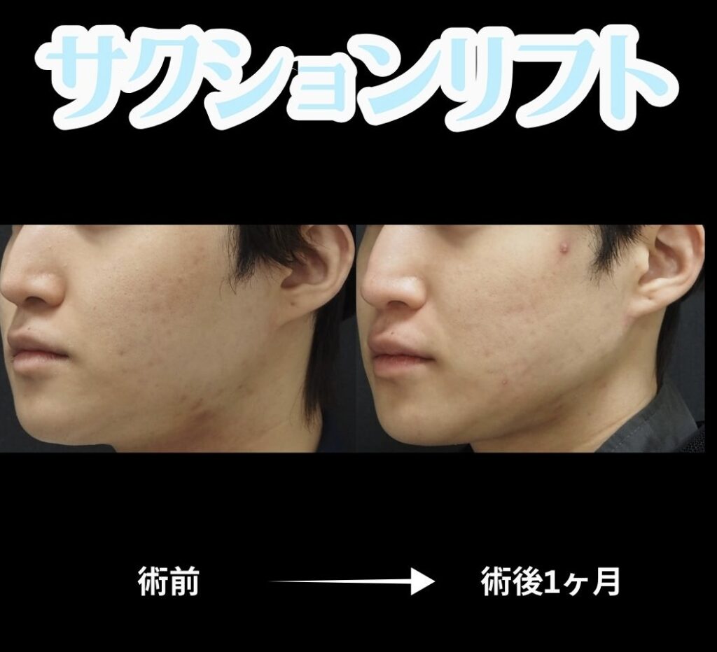 サクションリフト(メンズ)の症例写真