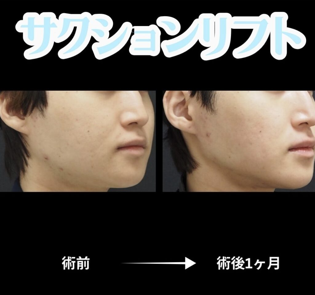 サクションリフト(メンズ)の症例写真