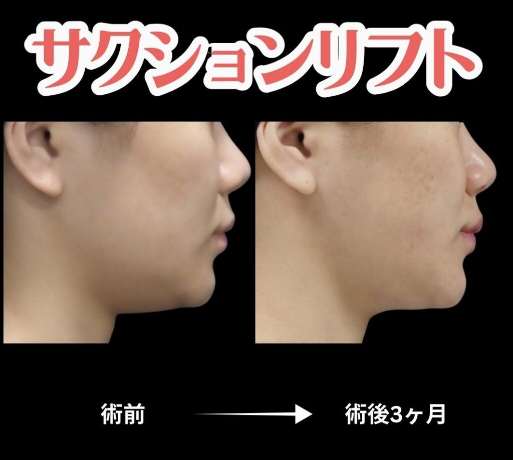 サクションリフトの症例写真