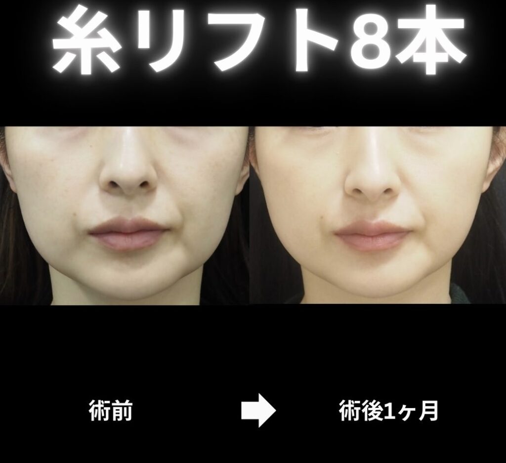 糸リフト８本の症例写真