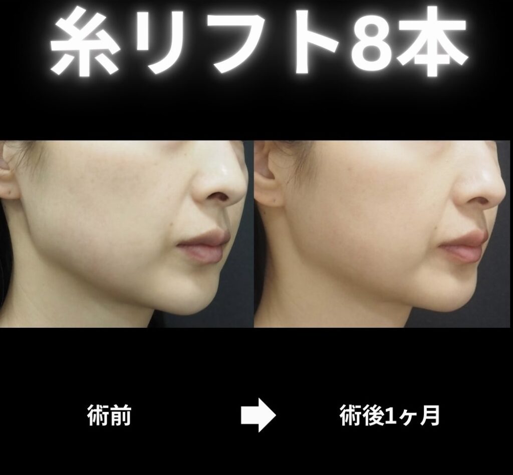 糸リフト８本の症例写真