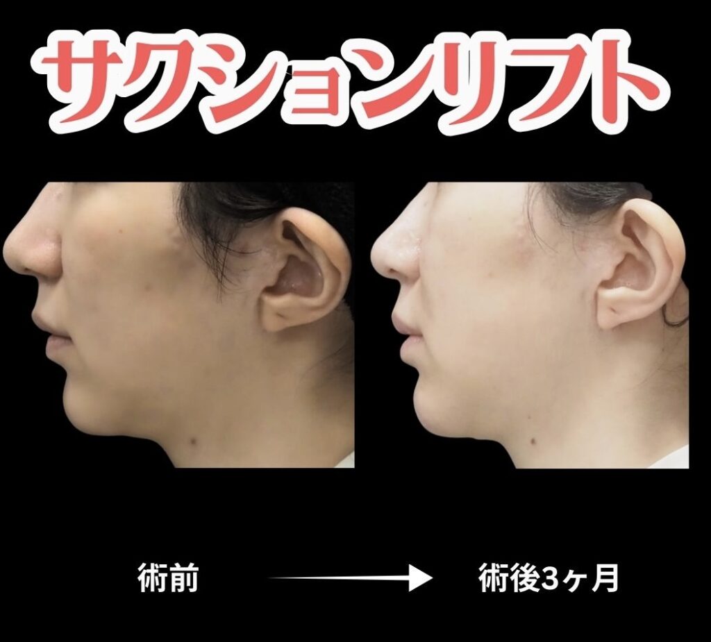 サクションリフトの症例写真