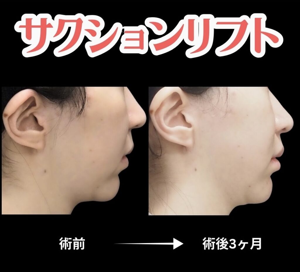 サクションリフトの症例写真