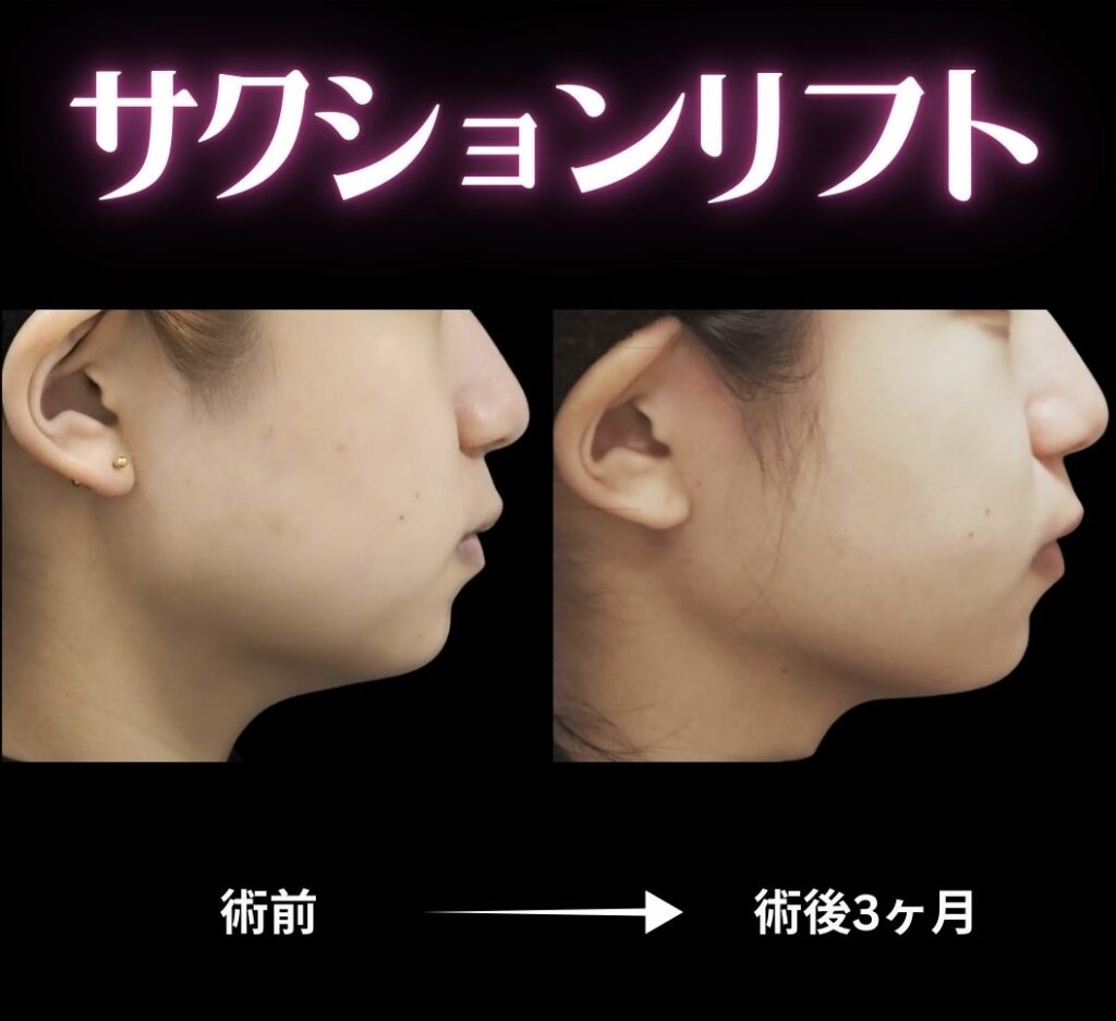 サクションリフトの症例写真