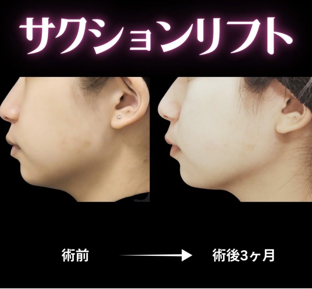 サクションリフトの症例写真