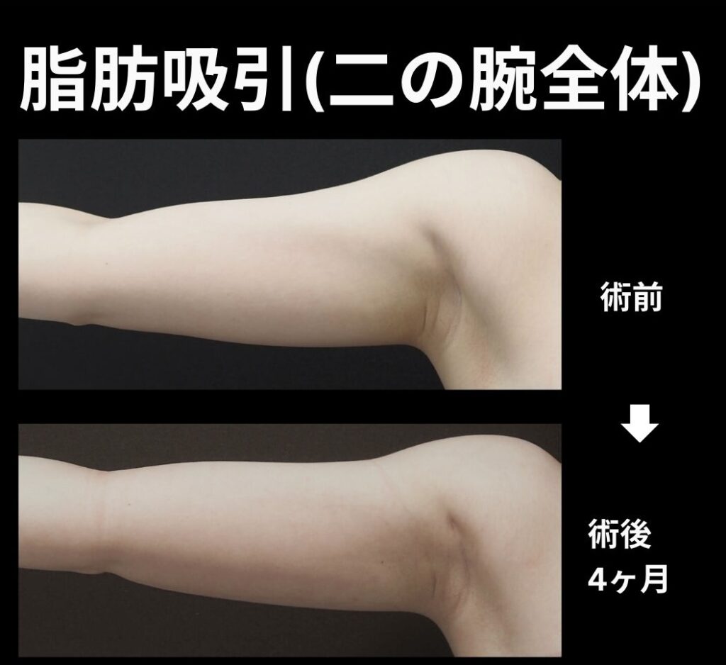 二の腕全体脂肪吸引の症例