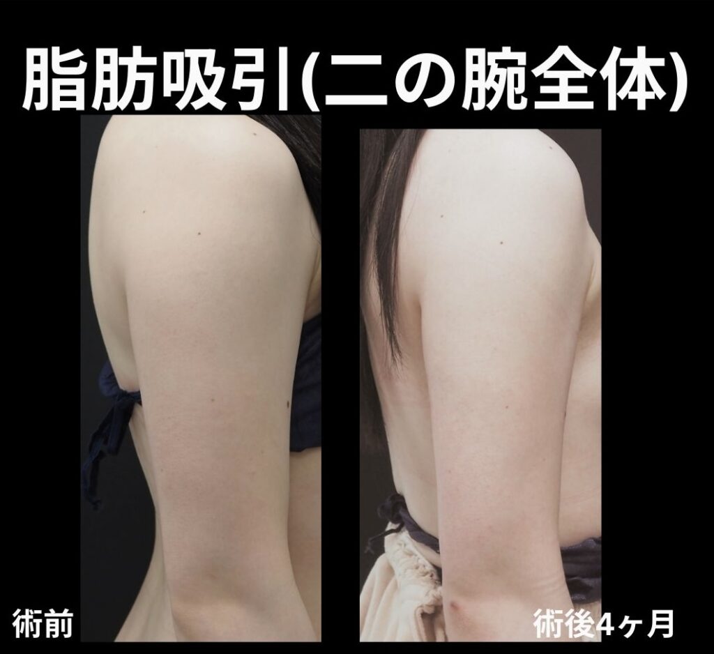 二の腕全体脂肪吸引の症例