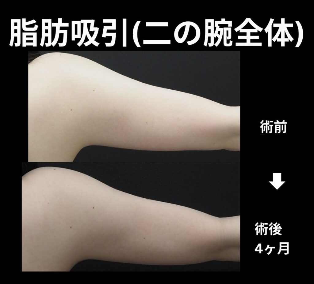 二の腕全体脂肪吸引の症例