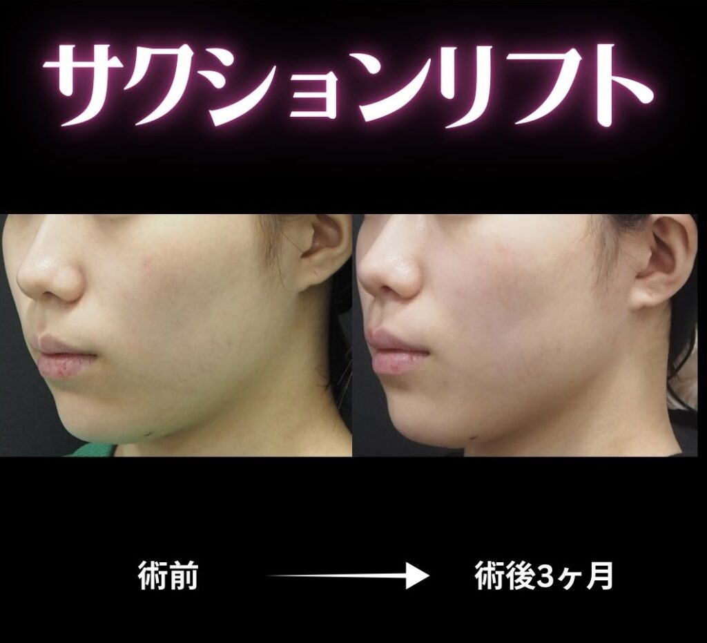 サクションリフトの症例写真