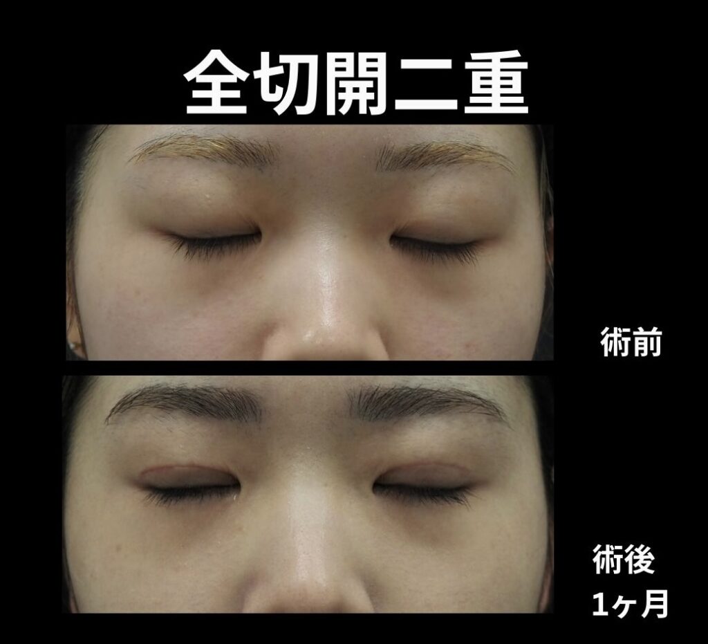 全切開二重術の術前後写真