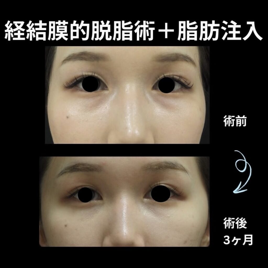 経結膜的脱脂術＋脂肪注入(目の下）の症例写真