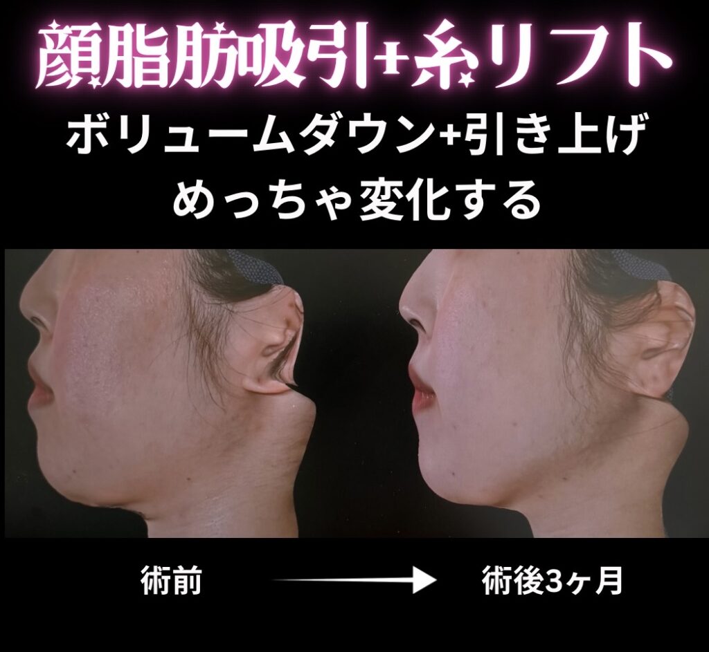 顔脂肪吸引＋糸リフトの症例写真