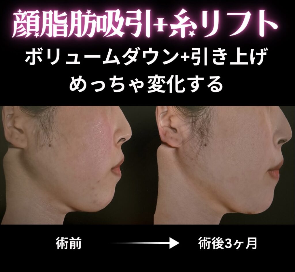 顔脂肪吸引＋糸リフトの症例写真