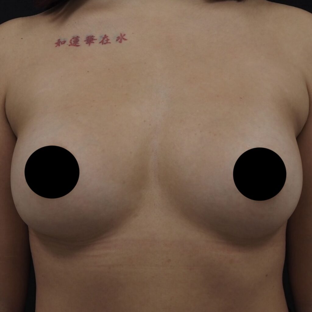 脂肪豊胸の術後3ヶ月画像