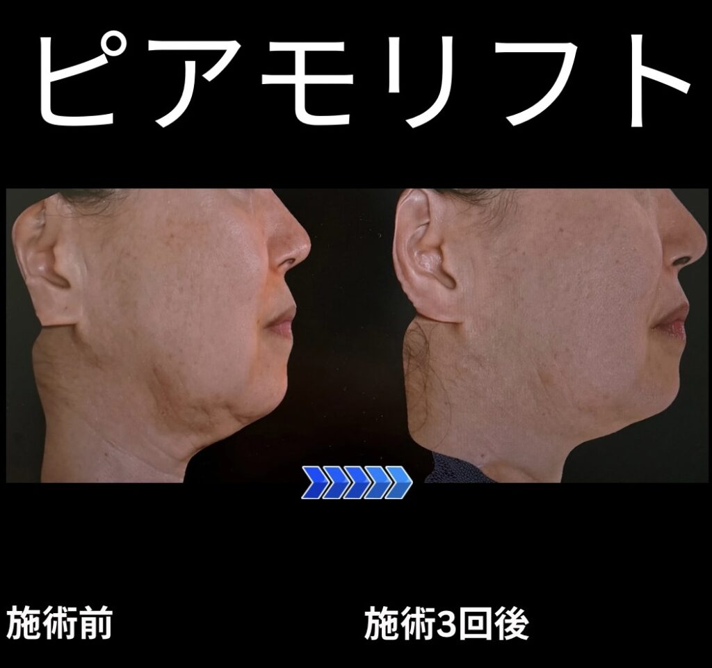 ピアモリフトの症例写真