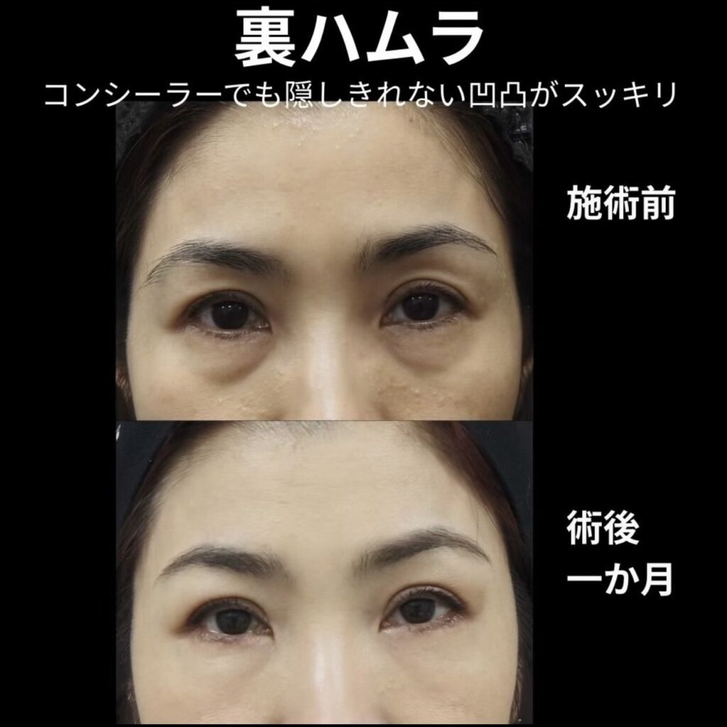 裏ハムラ法の術後１ヶ月写真