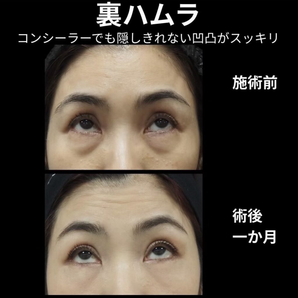 裏ハムラ法の術後１ヶ月写真