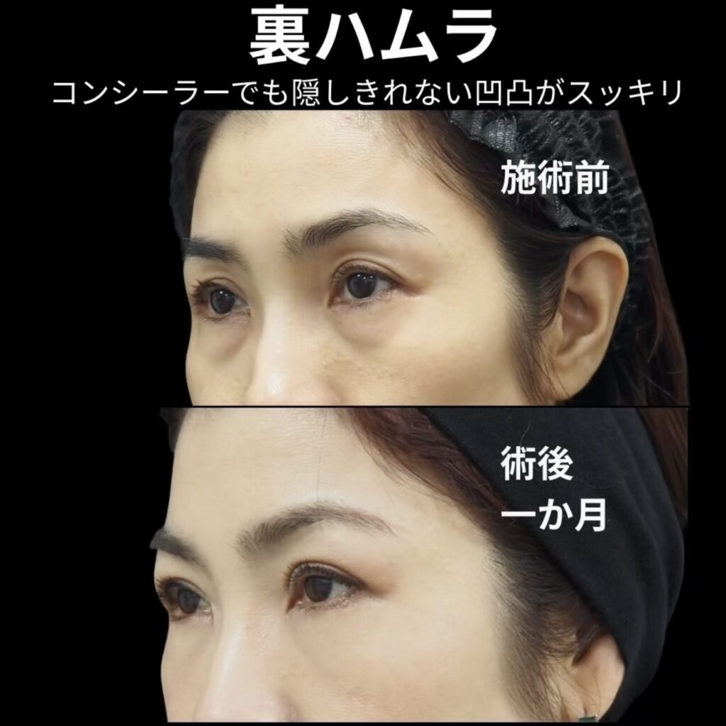 裏ハムラ法の術後１ヶ月写真