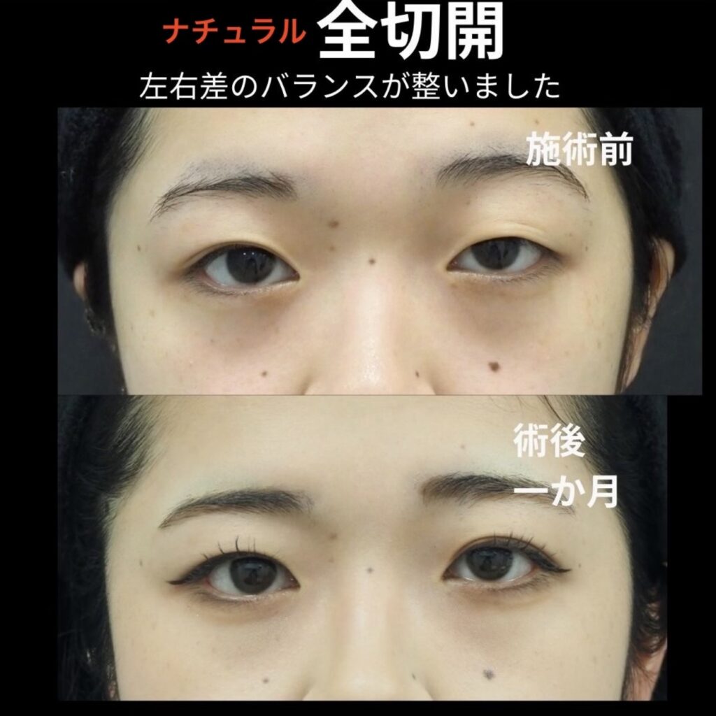 全切開二重術の症例写真