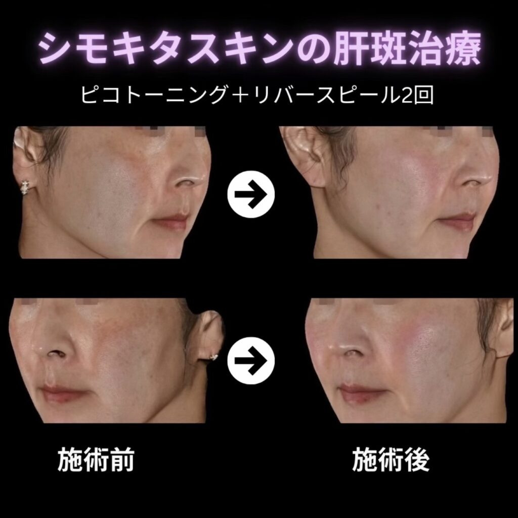 肝斑治療の症例写真