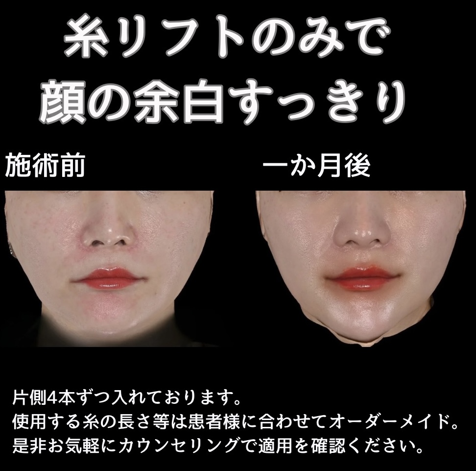 糸リフトの症例写真