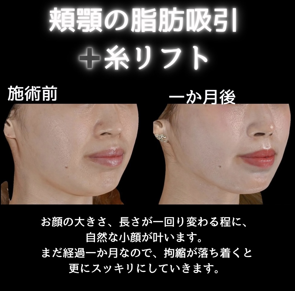 頬顎の脂肪吸引＋糸リフトの症例写真